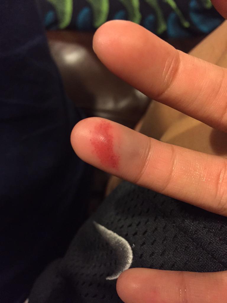 clairrebearrr's tweet photo. Ouch. http://t.co/ZLRtyo6xoY