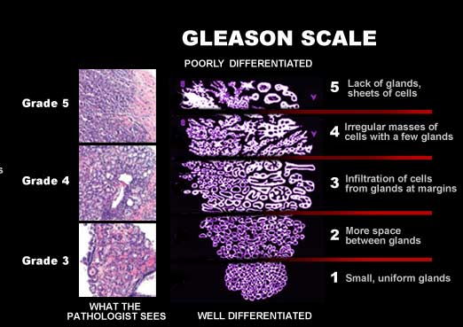 Глисон рак предстательной. Шкала Grade онкология. Классификация Глисона. Классификация Глисон предстательной железы. Grade 3 в онкологии что это.