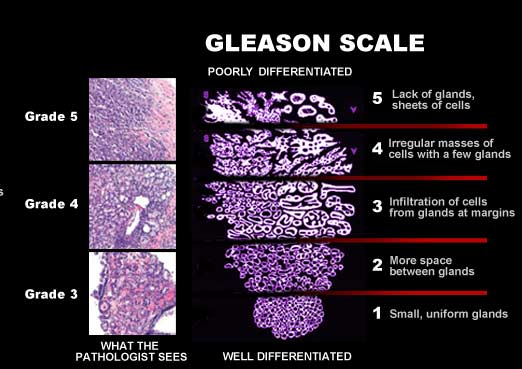 What does stage 2a prostate cancer mean What does stage 2a prostate cancer mean