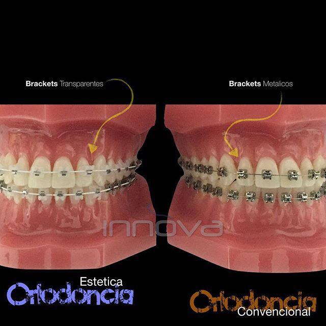 innovaespec's tweet photo. Ortodoncia Estética!, aquí en #Lecheria la puedes obtener con nuestros profesionales!!, no te da curiosidad? http://t.co/24Q7LWDyCl