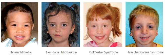 SherylLewinMD's tweet photo. #Microtia may occur with syndromes: #HemifacialMicrosomia #Goldenhar #TreacherCollins http://t.co/YXMSmbm57t http://t.co/wXE0Bng7nT