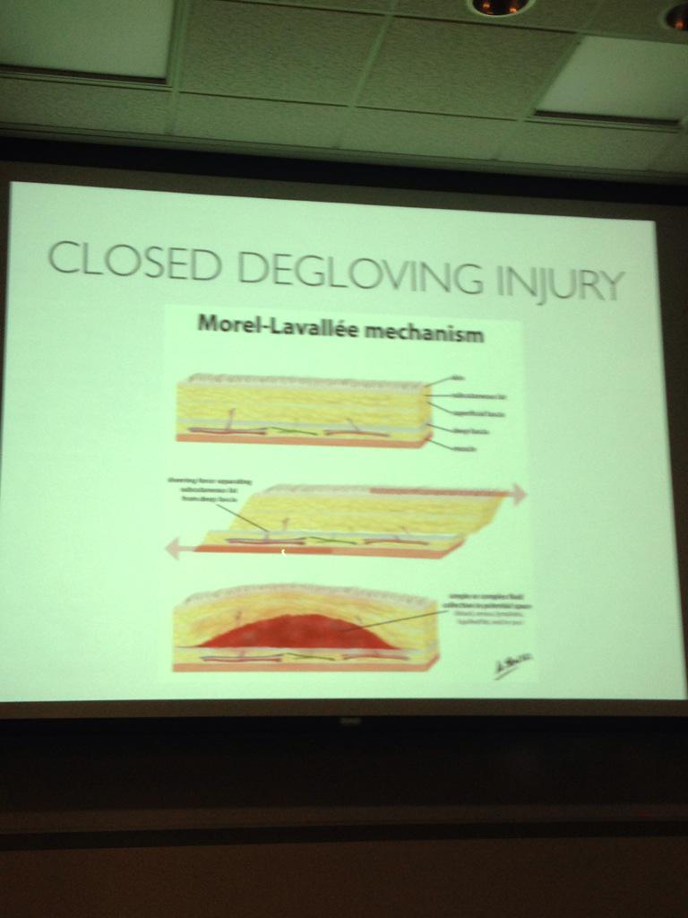 WashU EM Residency on Twitter "MorelLavallee shear force causes