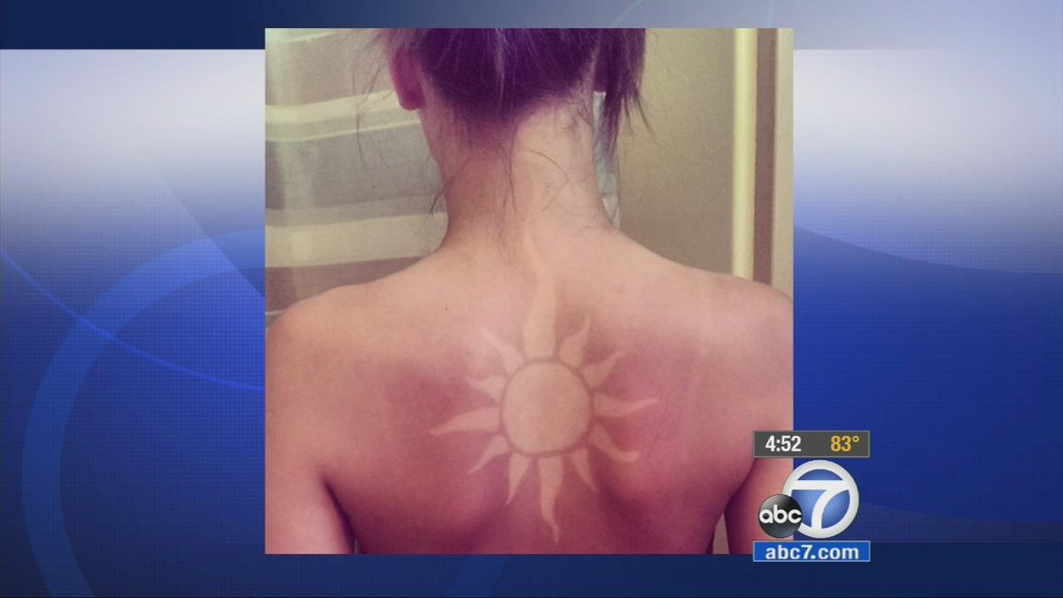 ABC7's tweet photo. Sunburn tattoo art becoming dangerous trend on social media http://t.co/usBB0bFjYH Dermatologists warn of melanoma http://t.co/pJClkzBHqP