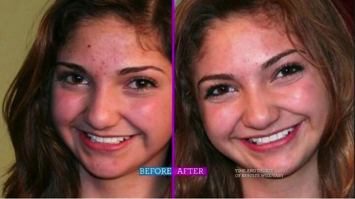 HeaIthyNotes's tweet photo. Do you struggle with acne? You must try http://t.co/s8hanBOpZs !🙆 guaranteed to clear your skin in 48 hours or less http://t.co/PYP04FKoIU