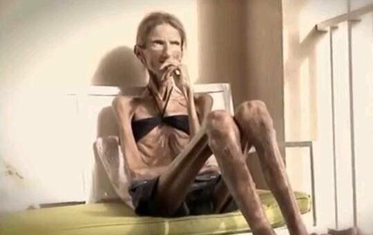 ギネス世界記録 A Twitteren 世界一細い女性 身長170cm 体重25kg ヴァレリア レヴィティーナさん 39歳 は 世界一痩せている女性として知られる人物 学生の頃は60kg近い体重があったが拒食症になり痩せてしまった Http T Co Kxarbufecl