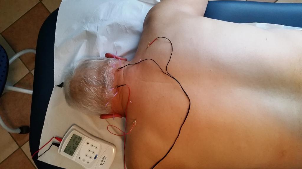 cale86's tweet image. #dryneedling #Dizziness #neckpain #Physiotherapist #fisiokinetic