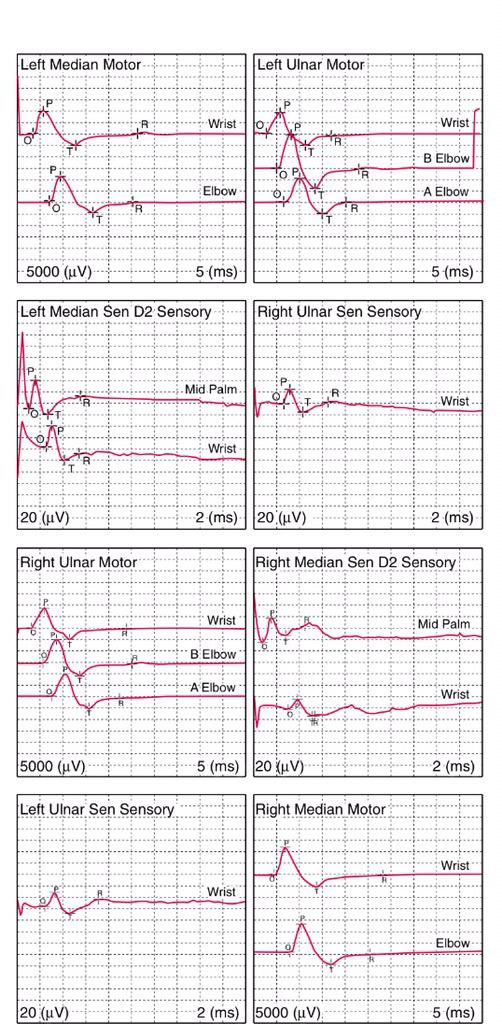 Estudio de #Neuroconducción motora y sensitiva. #EMG