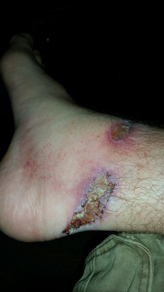 danlarwill's tweet photo. Rope burn from dog lead. Got caught round ankle when he run for the ball. Bit saw. http://t.co/Vu759YuFSP