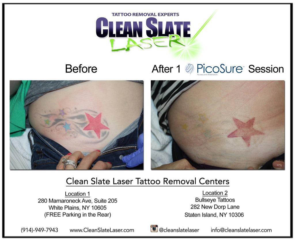 clean slate laser tattoo removal
