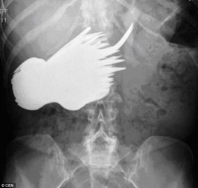WayofLiving_it's tweet photo. Strangest Things Doctors Have Found in People’s Stomachs http://t.co/Jg6uxPuIaH http://t.co/1dAenAiJKs