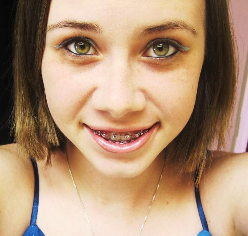 Girls With Braces On Twitter Stare Braces 7igmhse9m2 1fsrderb8f