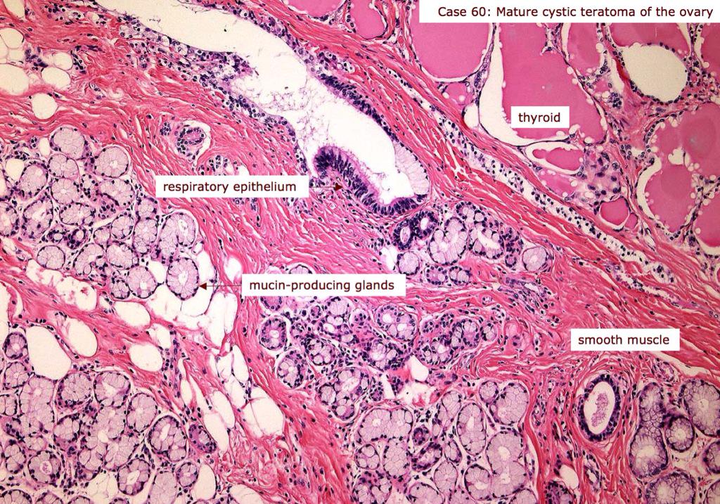 Mature Teratoma 48