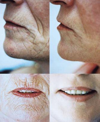 HCarexpert's tweet photo. Molding Lip: Erase wrinkles around the lips, from Molding Mask formula http://t.co/DT3GSVJaSC #moldinglip http://t.co/j4V3vabdxk