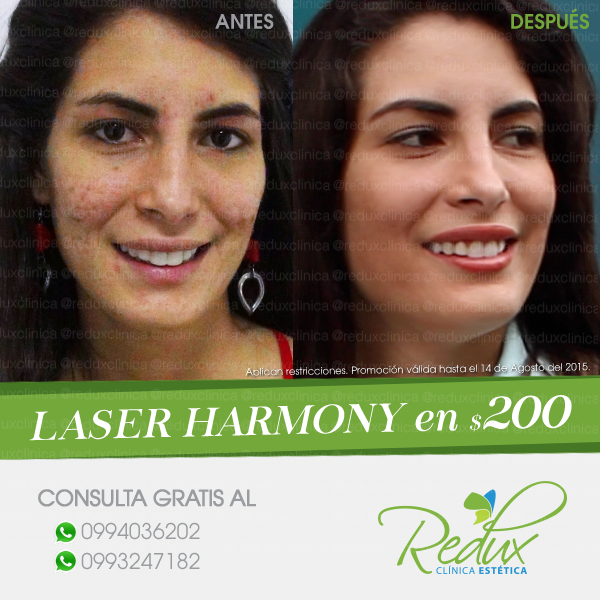 SecretosTV_'s tweet photo. Mira el #cambioRedux con #laserHarmony elimina #acné #manchas #secuelas por tan solo $200 #ConsultaGratis 0994036202 http://t.co/akh18D9SVO