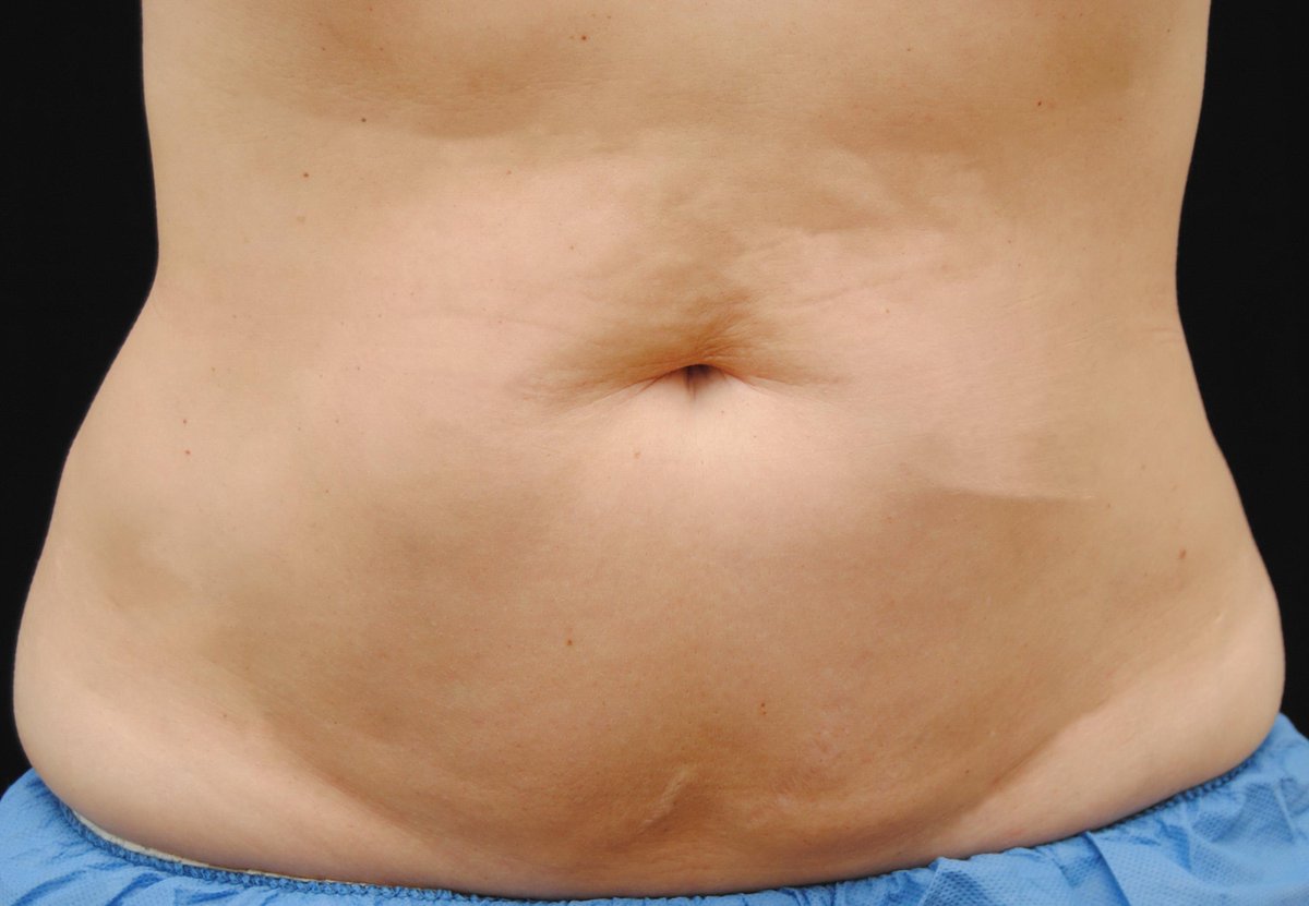 McLeanClinic's tweet photo. @TheTorontoSun We have the best CoolSculpting team in the GTA! The results speak for themselves! http://t.co/5Pojck64Wz