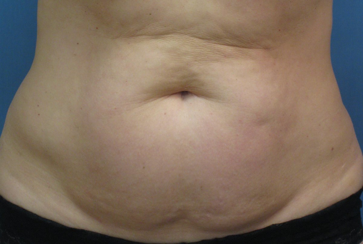 McLeanClinic's tweet photo. @TheTorontoSun We have the best CoolSculpting team in the GTA! The results speak for themselves! http://t.co/5Pojck64Wz