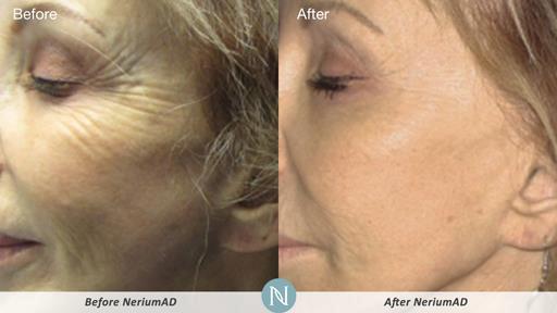 neriumjulie's tweet photo. Para que exponerse a una cirugía plástica, si puede lograr resultados asombros con el uso continuo de #Nerium http://t.co/9BdOo4tShR