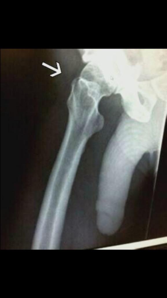 DeffJanker's tweet photo. Tree stand awareness week  @HSSVest don't be like @Jipper_Chones and fracture your bones.... http://t.co/2CAUtwLnd7