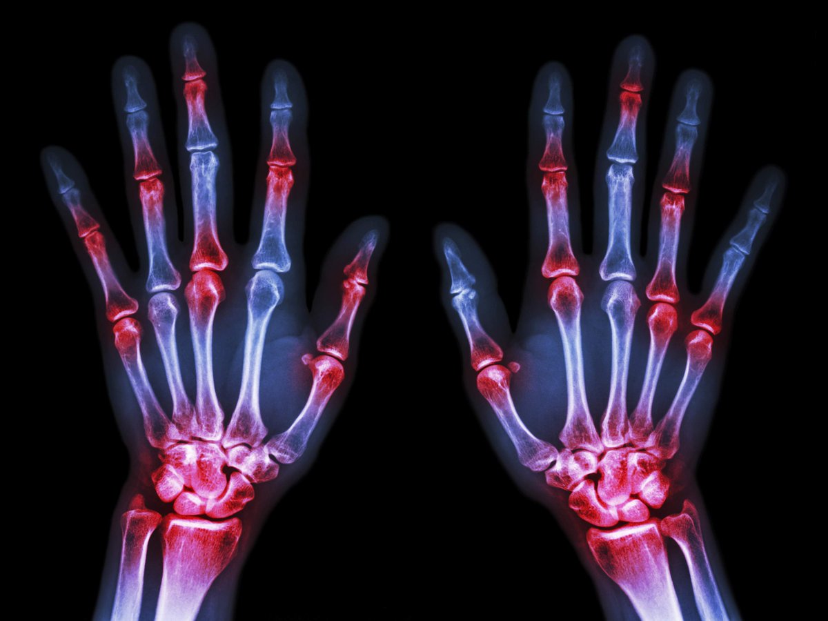 BIOFLEXLaser's tweet photo. Troubled by #arthritis? Check out how #BioFlexLaser therapy can help you! http://t.co/nb1nxkeTqW http://t.co/KljIs7xWRQ