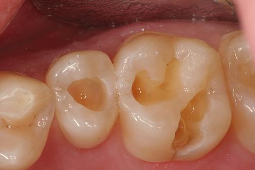 JeviCool's tweet photo. 10 ways How to heal cavities naturally. Stop wasting money w/ your dentist before reading this http://t.co/EE2CNmiJxi http://t.co/Z4pQytJzuN