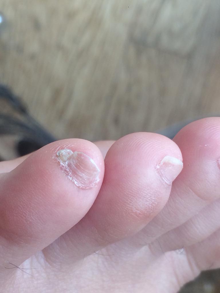 Goliutan Twitter પર 左足 右足 小指の爪が死んでる てか右足の小指の爪ないに等しい Http T Co Zracr30z96