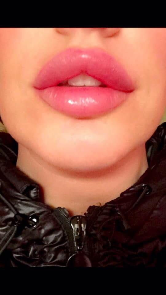 SkinSolutionLIV's tweet image. Where getting quite a reputation for our #bespoke #lip #augmentations book in for your no obligation consultation 💋