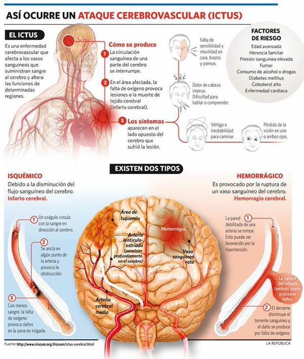 StopArtrosis's tweet photo. #Infografía Así ocurre el #Ictus http://t.co/AkboYK0fph