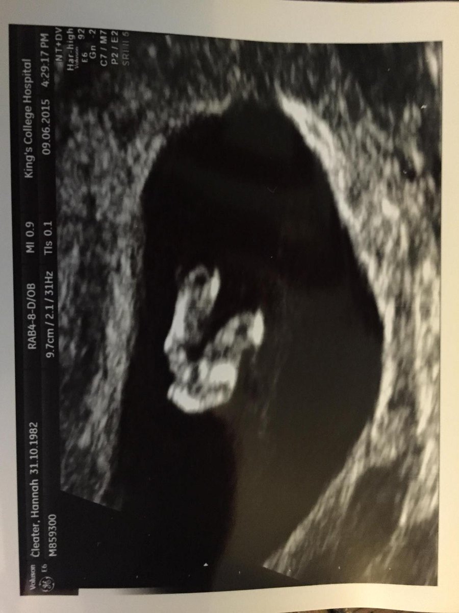 Hannah_Cleater's tweet image. This picture still makes me smile. #feet #14weeks #perfectlyformed