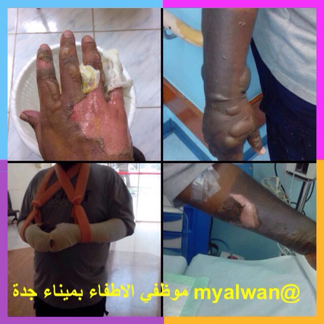 ab_alshrif's tweet photo. تعرض اثنان من أفراد الإطفاء بـ #ميناء_جدة لحروق إثر إنفجار حاوية #معاناة_موظفي_العقود_بالموانئ
@SaudiPorts @alamudi_n http://t.co/6aOJiuUn56