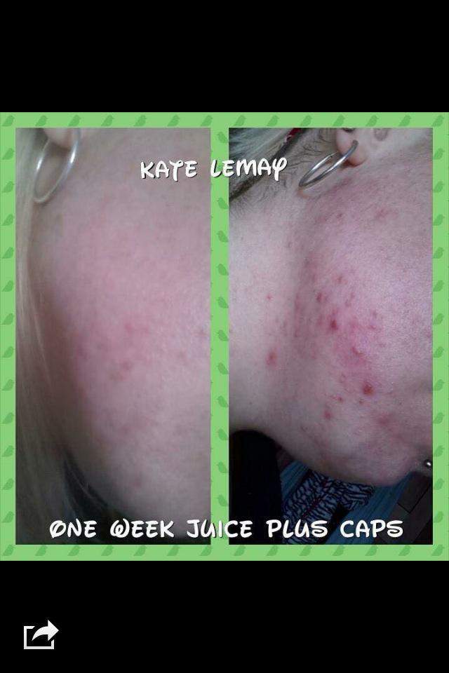 LaurenJuicePlu2's tweet image. One week skin transformation from using #JuicePlus capsules. Price plans available DM for info