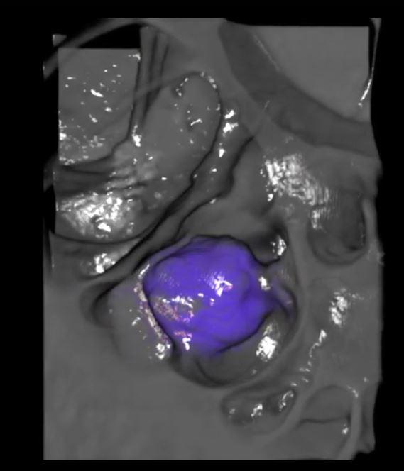 indicated's tweet photo. Our colorectal cancer case study module is now live on @Medscape. Scans from @TCIA_News http://t.co/sI0l2FaWdm http://t.co/vHCWYSHs53