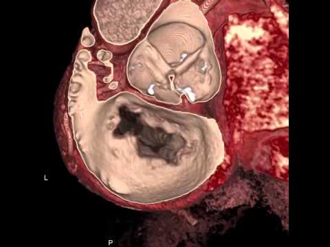 DrRumberger's tweet image. A short study using #vrrendering of a #ccta #heartscan of MVS Posterior #stenosis: goo.gl/PKZX5m