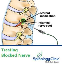 spinalogy's tweet image. #NerveBlock #RootBlock #FacetBlock Treatment! 
spinalogy.com/orthopedic.html