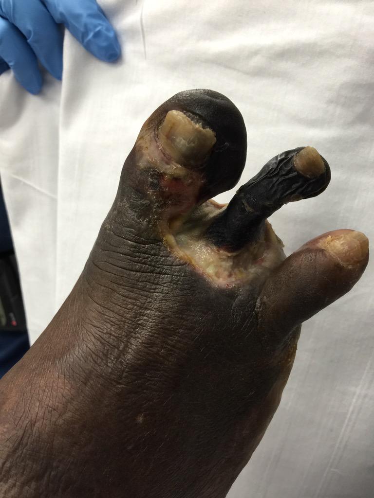 WoundSmart's tweet photo. Status post Transmetatarsal #Amputation for #Gangrene #PVD #diabetes #LimbSalvage http://t.co/EeX6bJsGYy