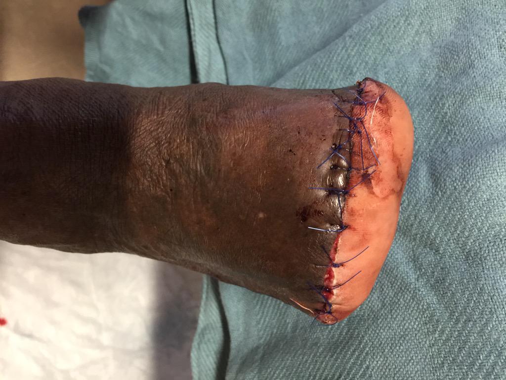 WoundSmart's tweet photo. Status post Transmetatarsal #Amputation for #Gangrene #PVD #diabetes #LimbSalvage http://t.co/EeX6bJsGYy