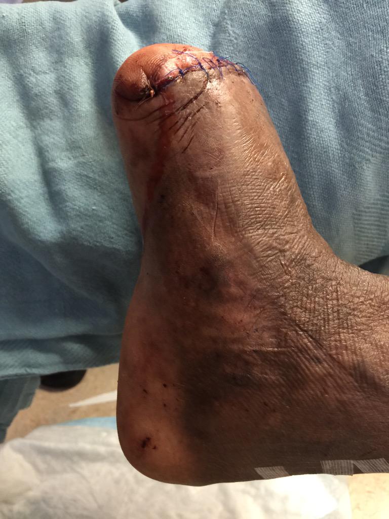 WoundSmart's tweet photo. Status post Transmetatarsal #Amputation for #Gangrene #PVD #diabetes #LimbSalvage http://t.co/EeX6bJsGYy