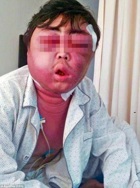 Girlsbook Twitterissa 中国で蚊に刺された男性 顔がパンパンに膨れ上がりアンパンマン状態に 2ヶ月以上腫れ引かず 特別な毒性を持つ蚊の可能性も Http T Co K9ucsjxdrd Http T Co Xgvuqkuj6c