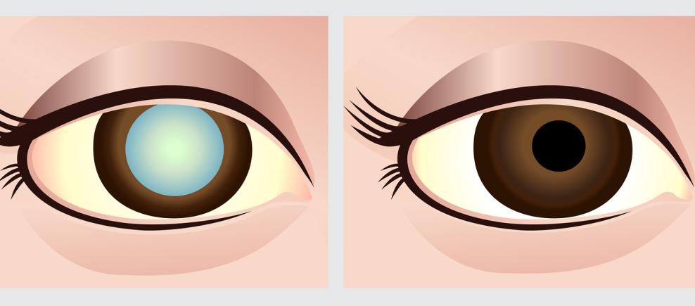 sunyopt's tweet photo. What is a cataract? http://t.co/84166MLQGk #UECHealthInsights http://t.co/t545bcafmd