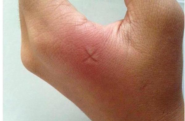 SpeakComedy's tweet photo. Who else do this when they get a mosquito bite? http://t.co/Lb22Q2iRf9