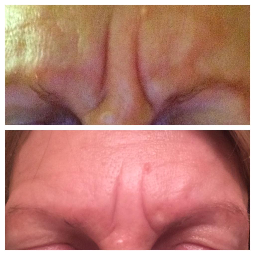 BarbJAllen's tweet photo. My deep elevens disappearing with R + F Acute Care patches!#randfacutecare #joinmeonthisjourney #getapieceofthepie http://t.co/xcILSdJwar