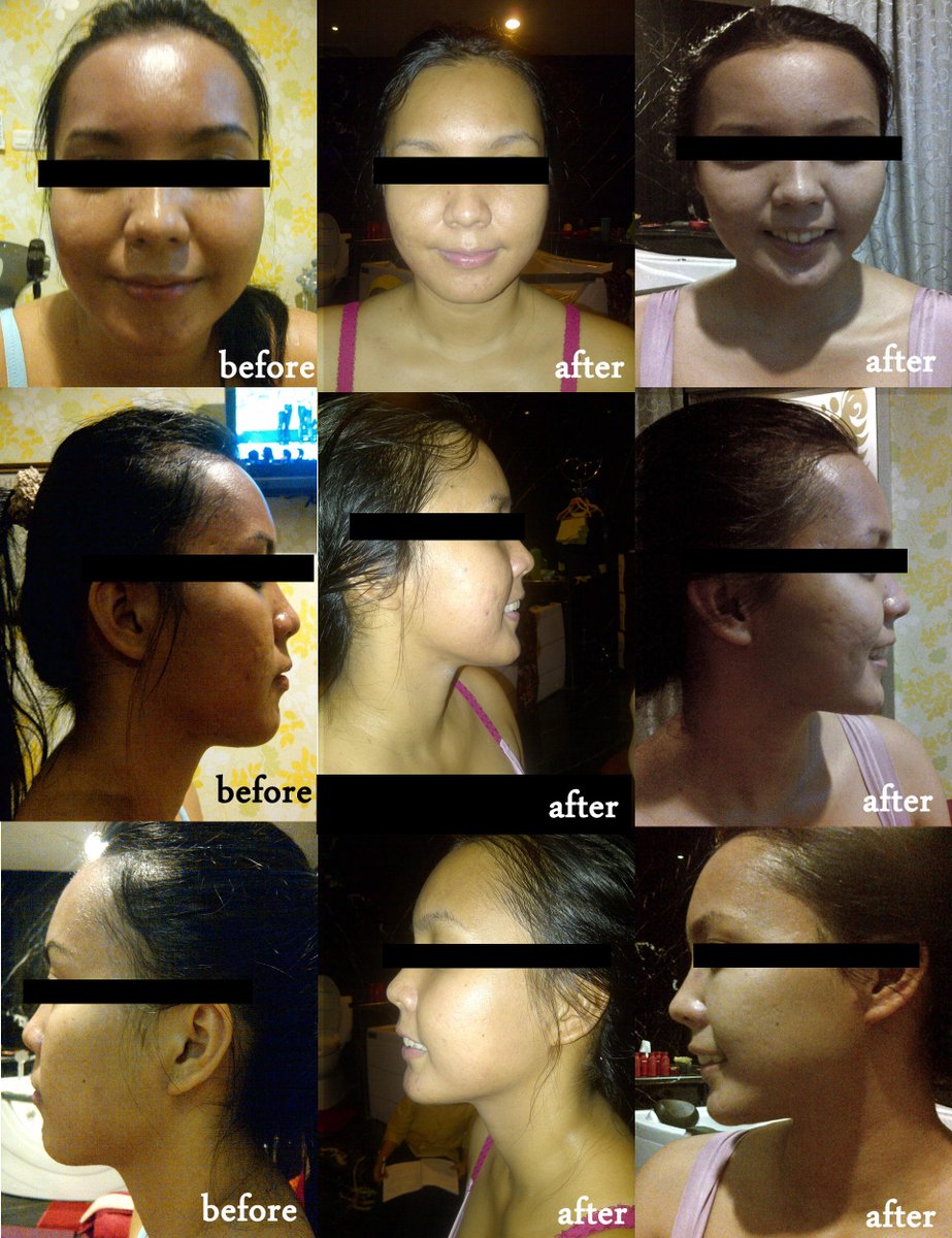 WDY_Semarang's tweet photo. BEST Treatment WDY,
Facelift, karna ditangani tenaga ahli yg handal &amp; didukung dg alat2 canggih
#facelift #wdoubleyou http://t.co/g37ivG1WJl