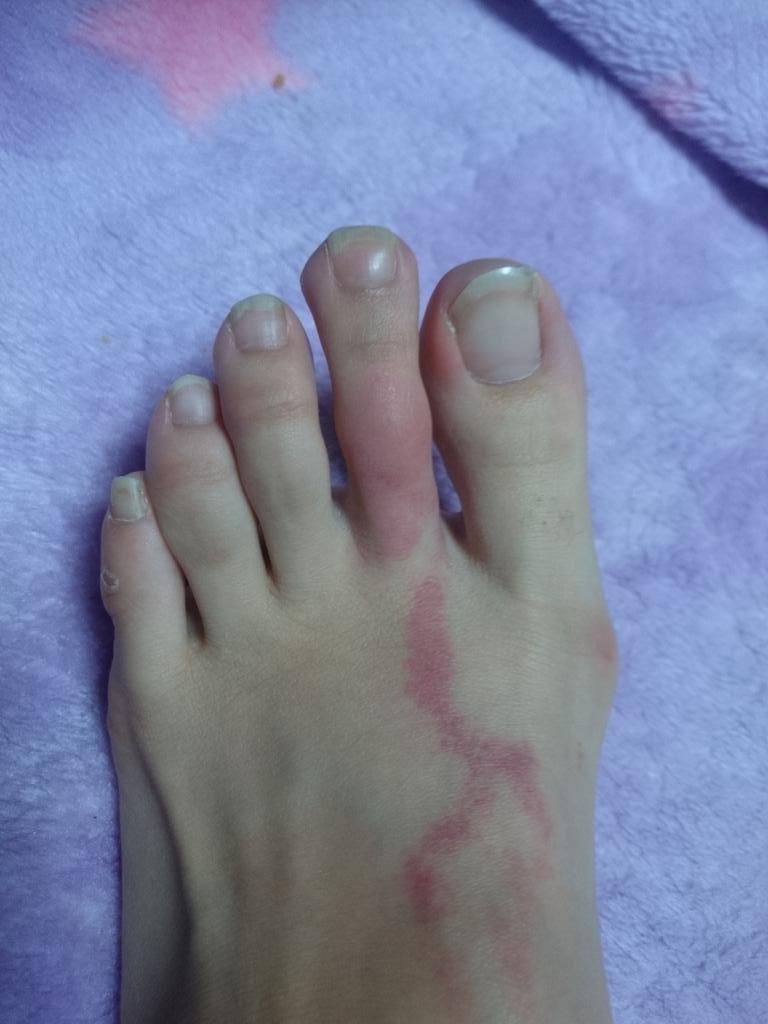 邪魔イカのてんぷら 7人目のスタンド使いやりたい Twitterissa Sharonight Shar 恐らく虫刺されです W 下の 赤い線は 調べたら虫刺されからのリンパ管炎かもしれないみたいです 痛いし痒いです W