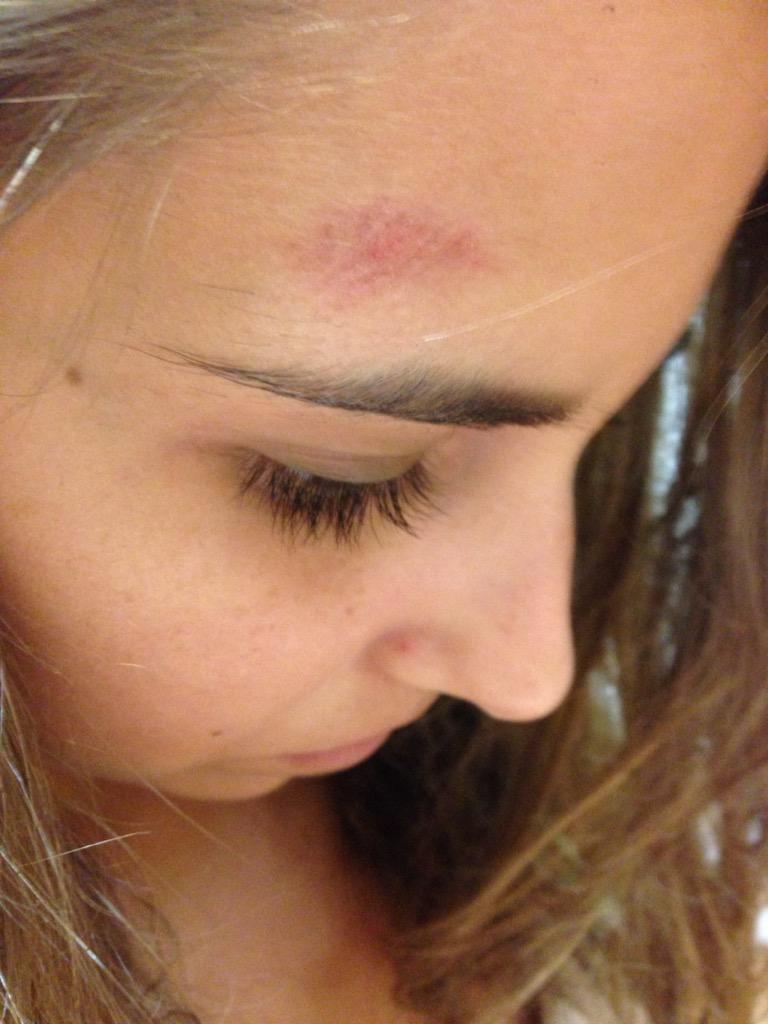 alexis_swick25's tweet photo. Fought the ground, ground won #maxthompson http://t.co/0sAbXSBv6s