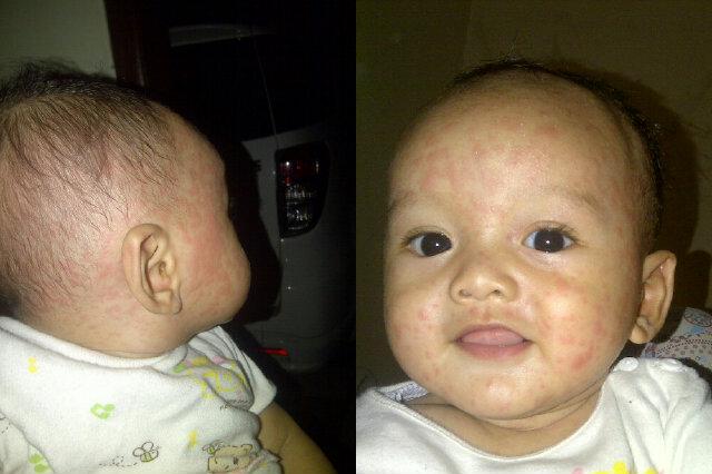 astriidmo's tweet photo. Gws sayangnya bundaaaa http://t.co/8lzg8ra3wZ