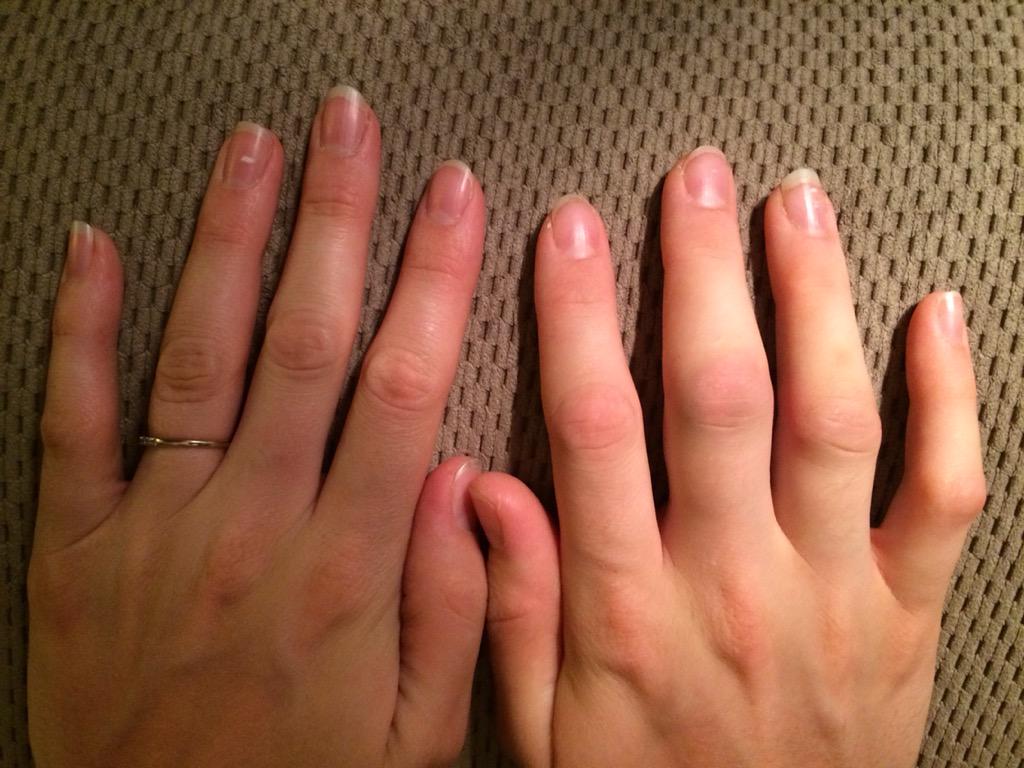 Hofblakester's tweet photo. Kittenball injury #timetoretire #lcdays http://t.co/23Bv6YuFrE