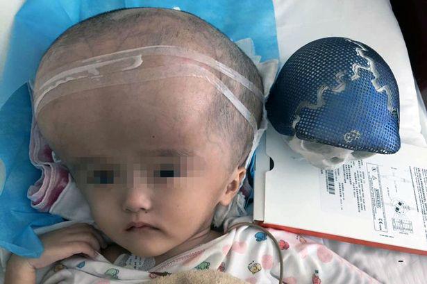 ISPNeurosurgery's tweet photo. Baby with giant skull has new one constructed using 3D printer before an incredible operation- http://t.co/kW6MrI2jIE http://t.co/vrAcLDhgg5