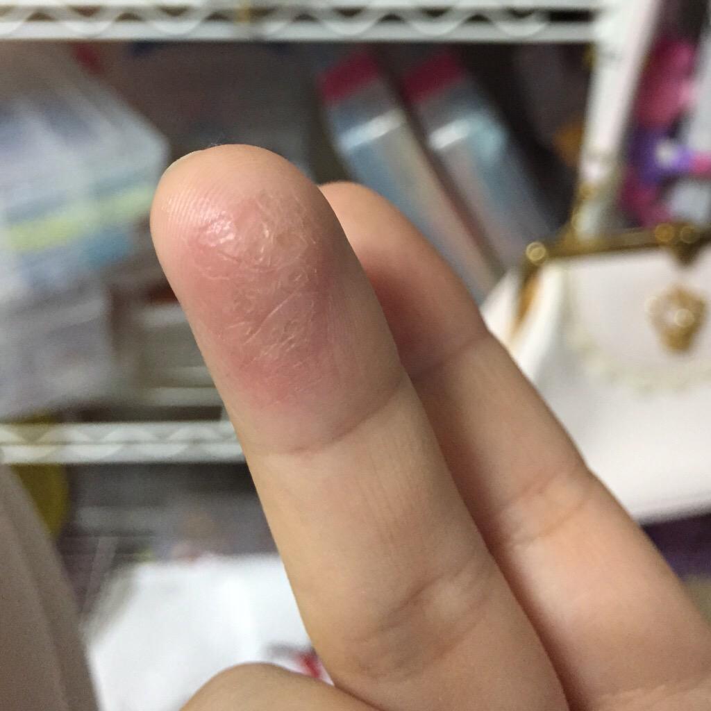 Holymel 主に右手の指の腹がすごい荒れるんです おかげさまで皮むけすぎて指紋ツルツル i i Http T Co Sjo75opkbe Holymel 主に右手の指の腹がすごい荒れるんです おかげさまで皮むけすぎて指紋ツルツル i i Http T Co Sjo75opkbe