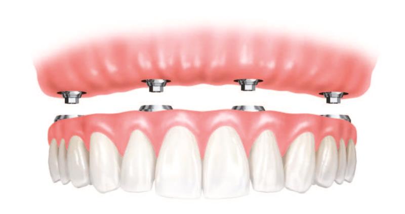 ebtsamatac's tweet image. زراعة الأسنان
تعتبر الحل الامثل لتعويض السن مفقود
بسن دائم فهي  جراحة بسيطة ومضمونة
3500للسن 
#الرياض0536870035واتسhttps://t.co/9kzDVK59dr