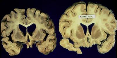 gtldnauk's tweet photo. Study reveals new '#genetic modifiers' of #Huntington's #disease http://t.co/818dCzOgWn http://t.co/5K37qyGtu3