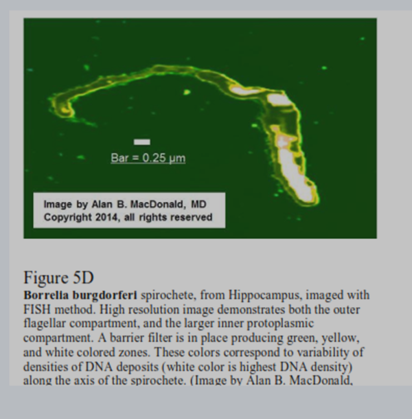AlzDisResearch's tweet photo. #Alzheimers New ResearchWith DNA ProbesBorrelia Infection INSIDE of
AlzheimerAmyloidPlaques http://t.co/eYju9BQPRP http://t.co/rDOZ32IhjI